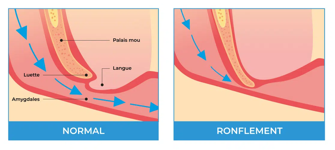 Schéma de la respiration nocturne normal et du ronflement