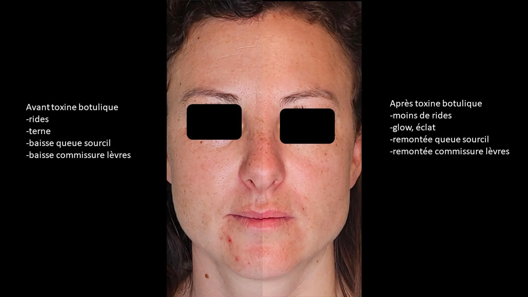 Injection de Botox par le Dr Nouwen