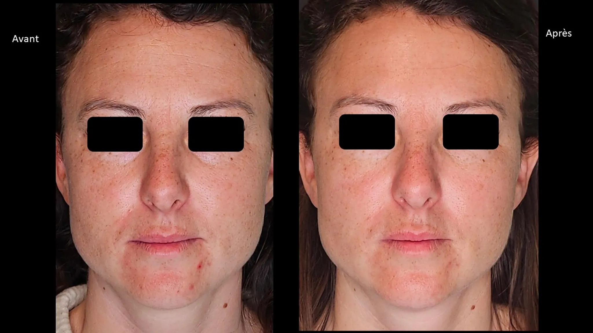 Injection de Botox par le Dr Nouwen