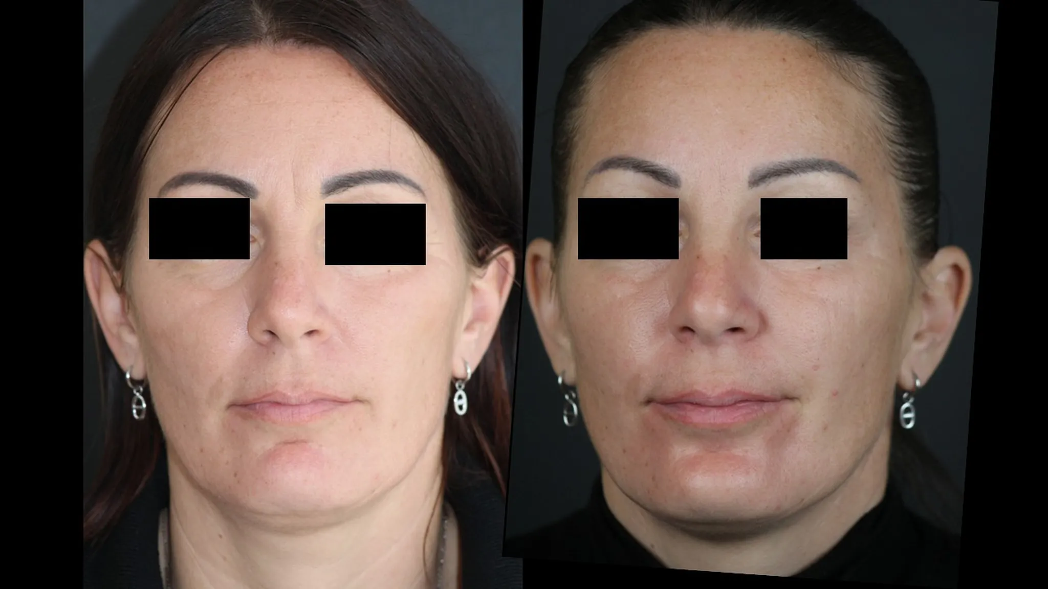 Injection de Botox par le Dr Nouwen