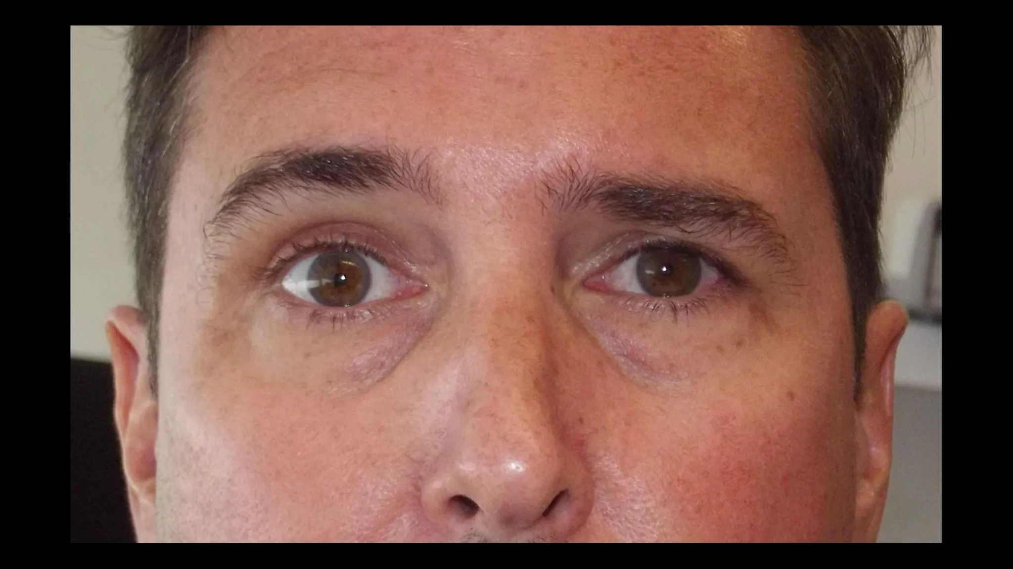 Brow lift réalisé par le DR NOUWEN