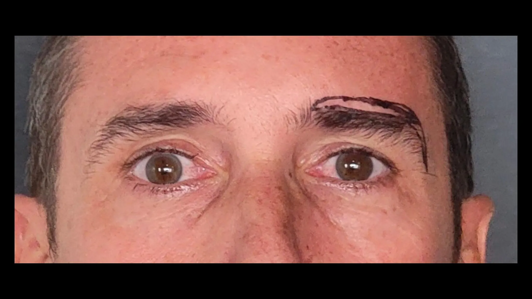 Brow lift réalisé par le DR NOUWEN