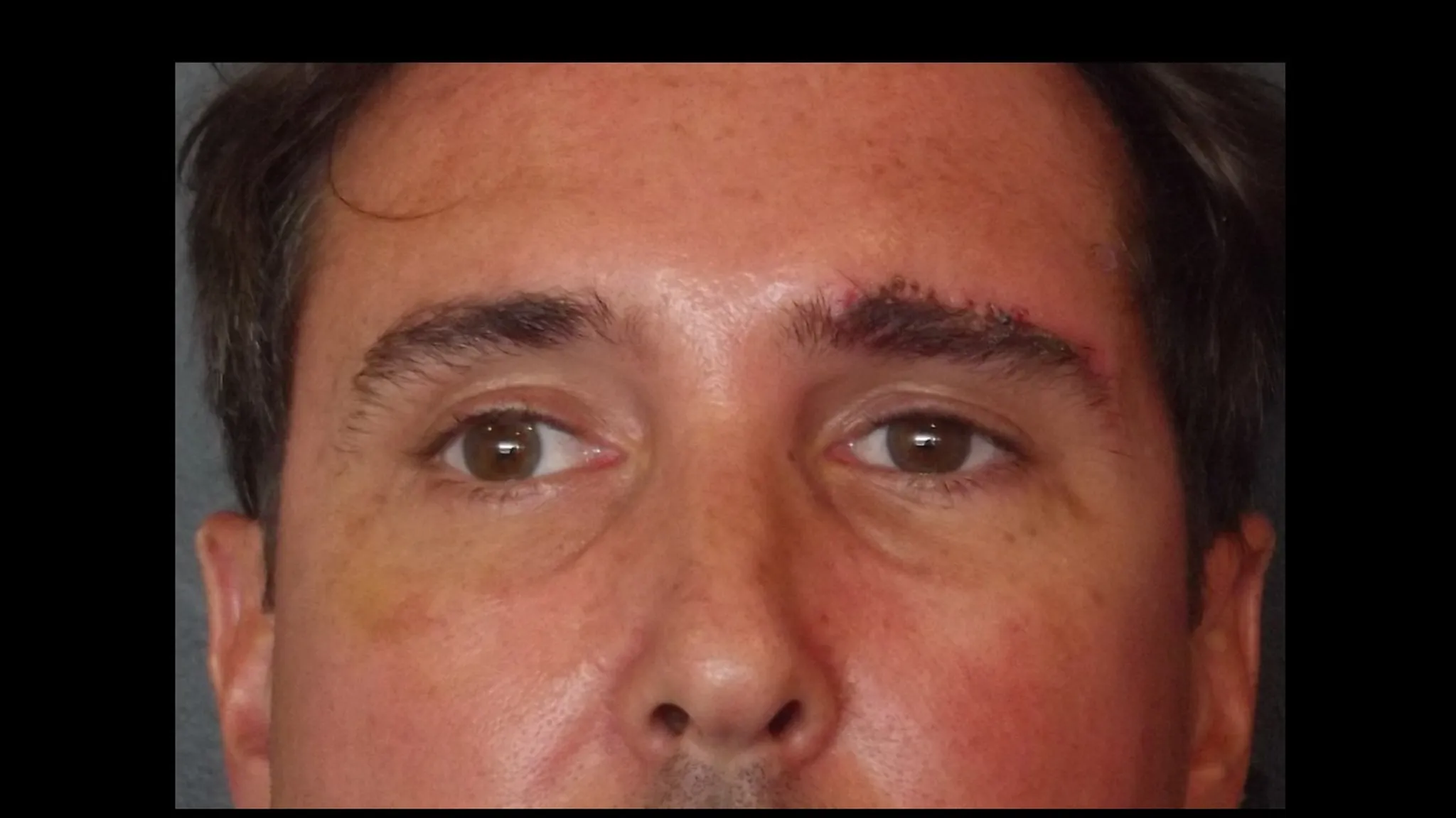 Brow lift réalisé par le DR NOUWEN
