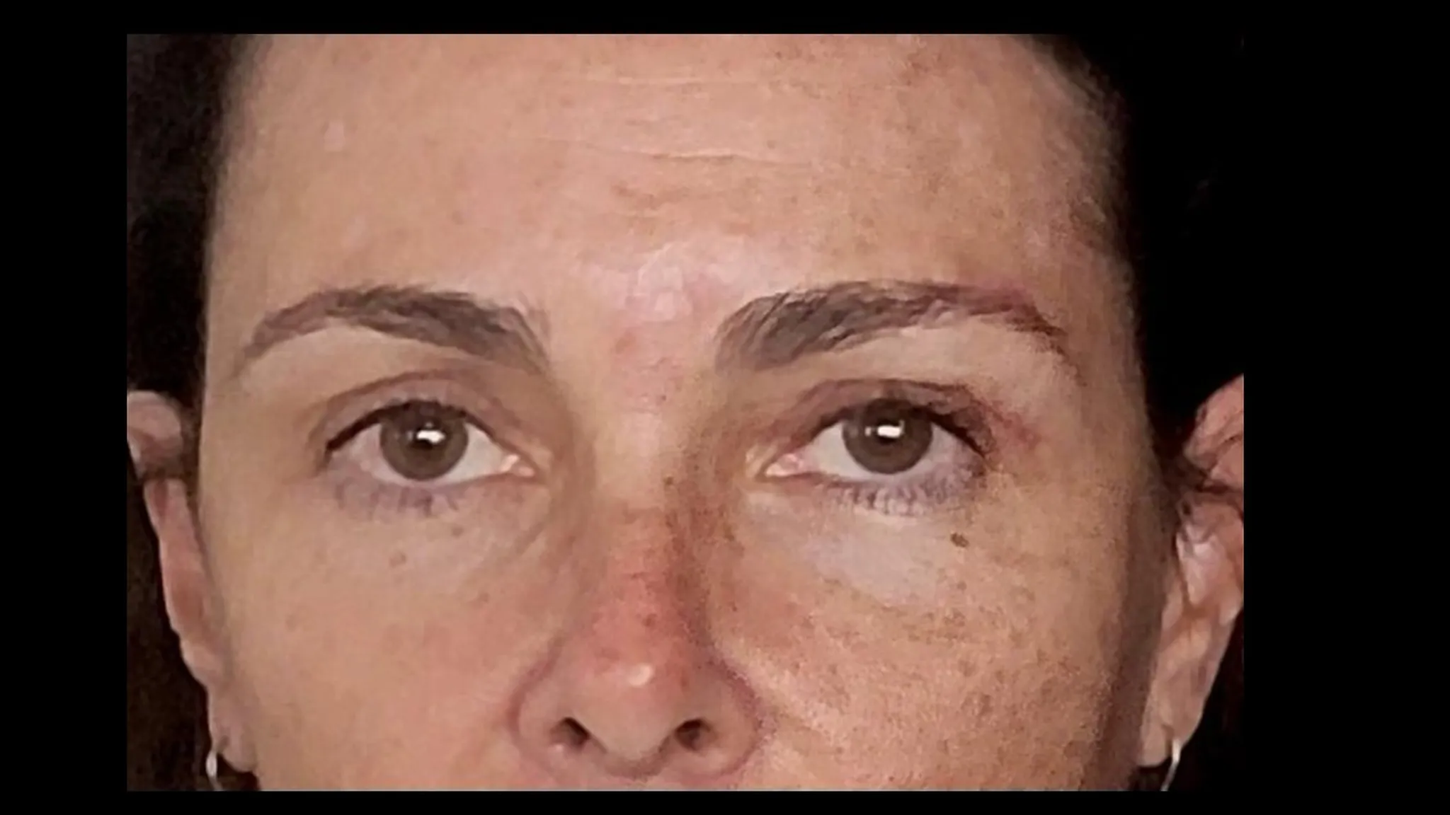 Brow lift réalisé par le DR NOUWEN