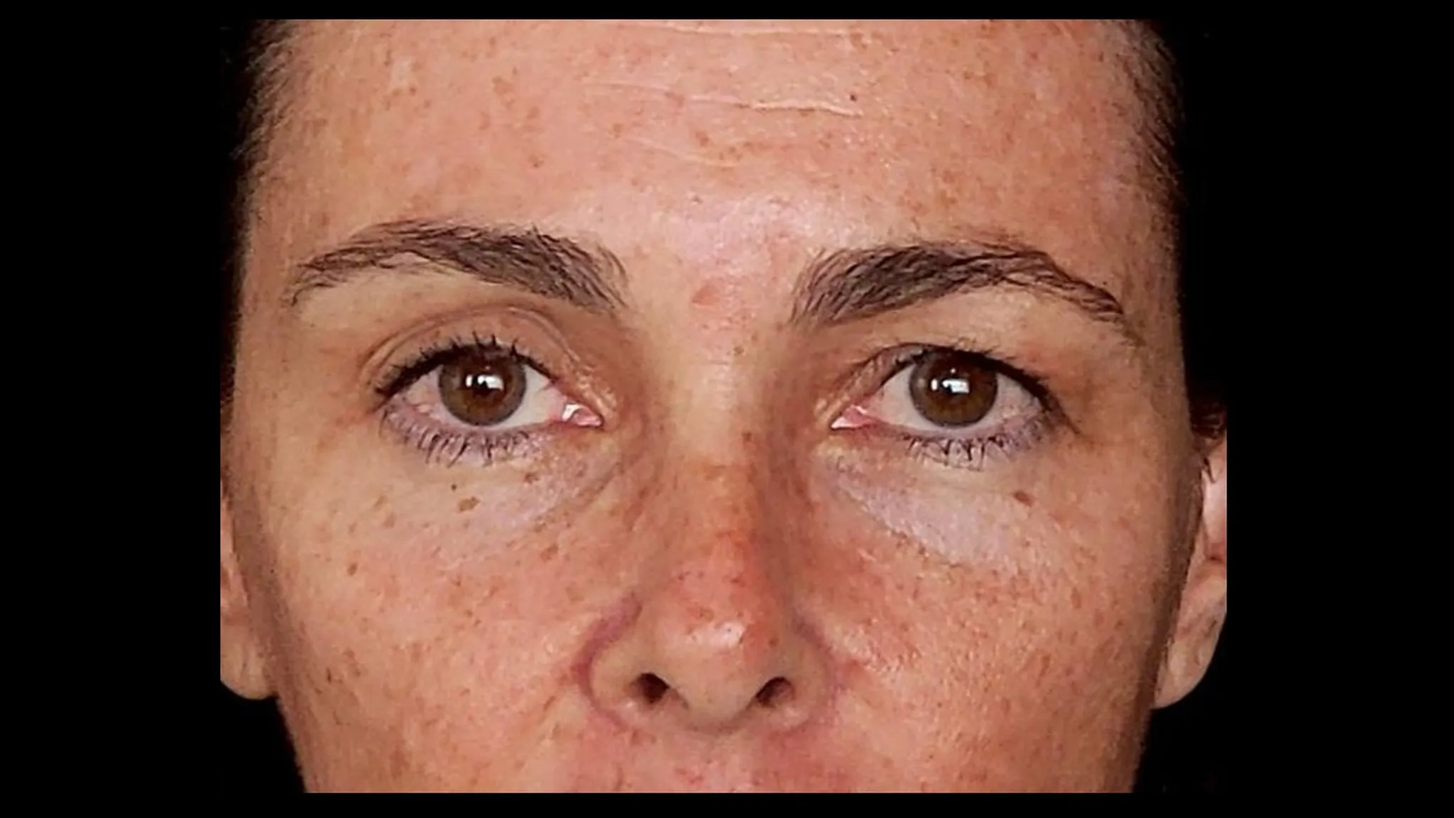 Brow lift réalisé par le DR NOUWEN