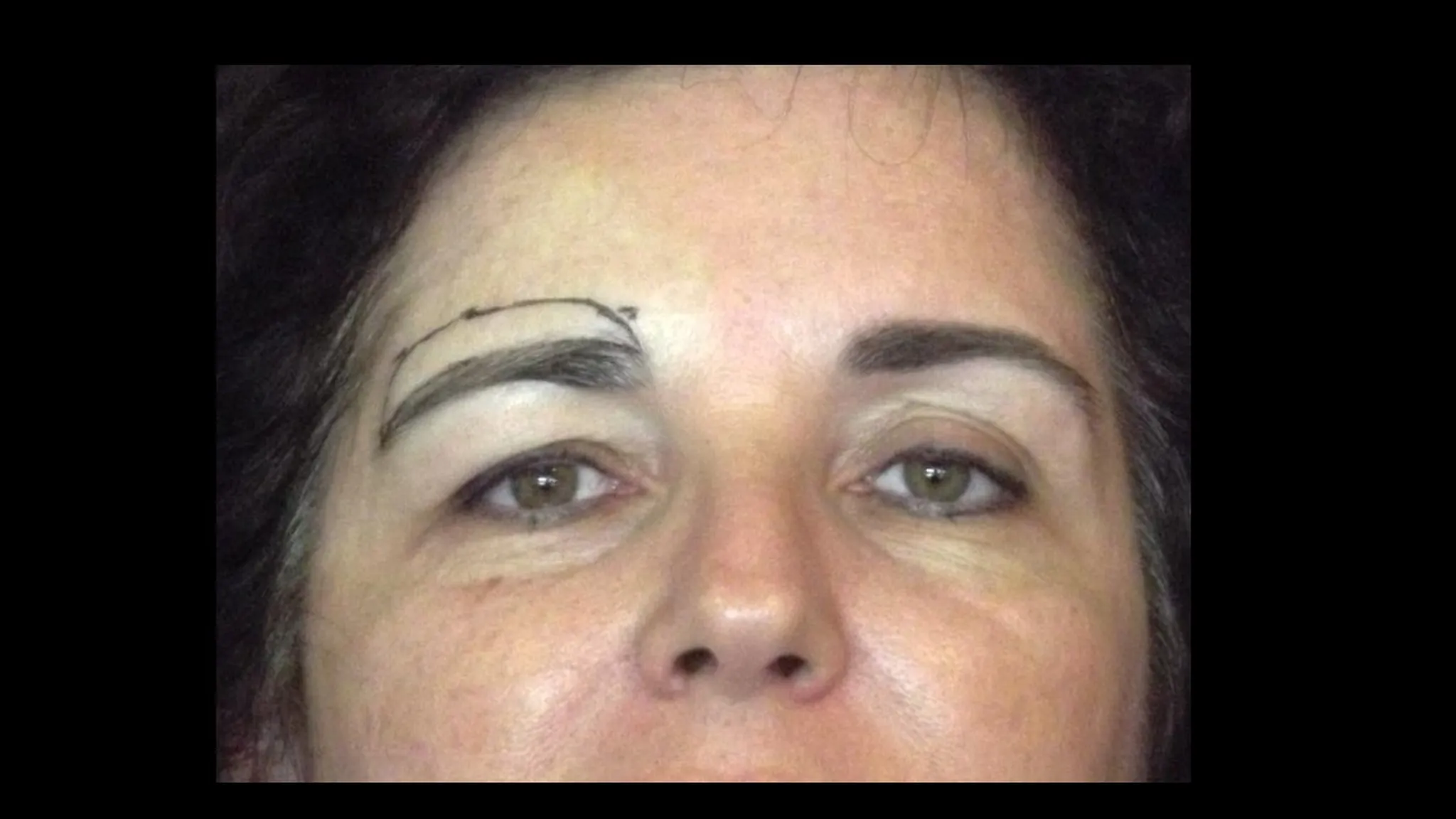 Brow lift réalisé par le DR NOUWEN