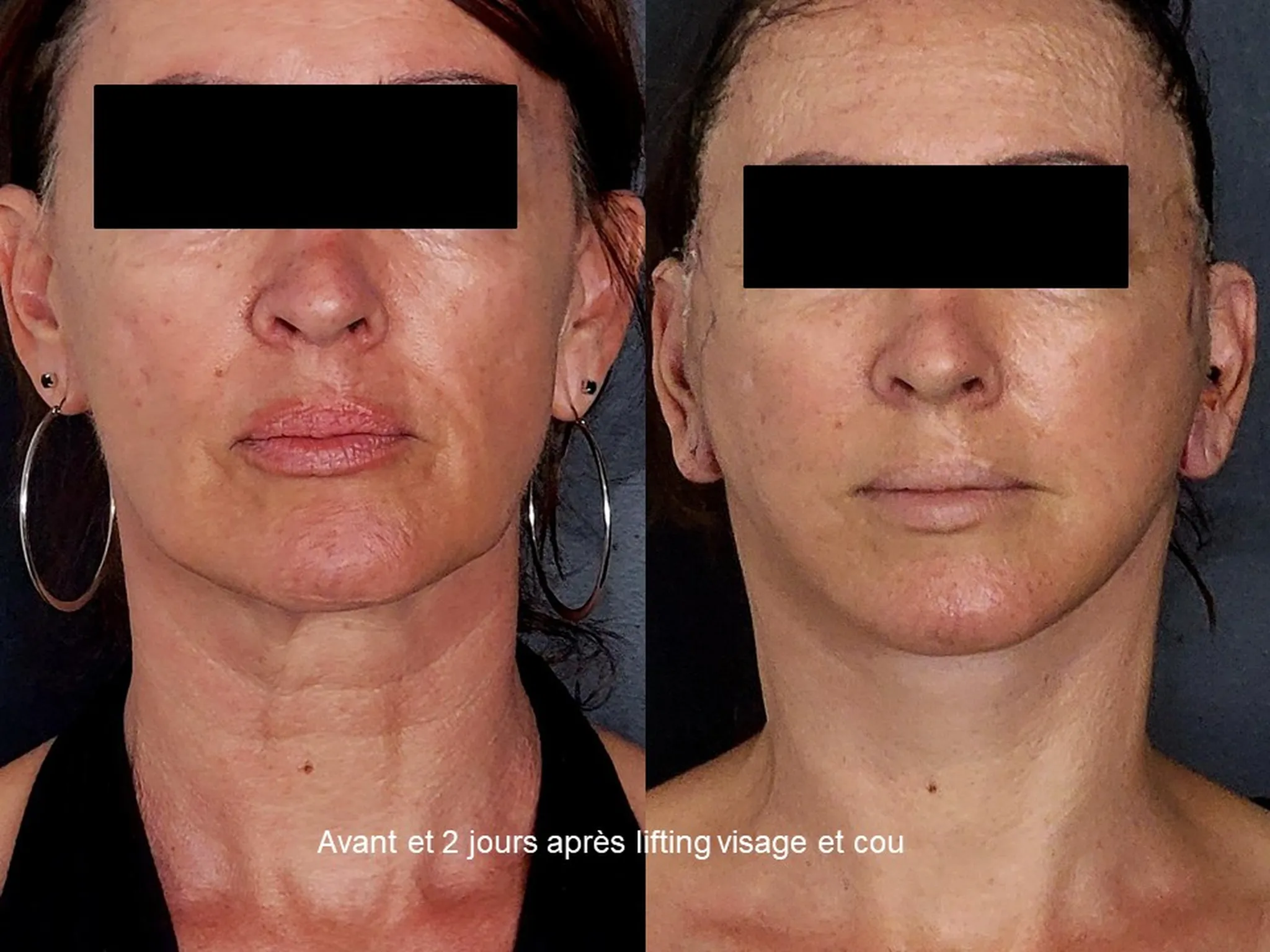 Lifting du visage sur femme