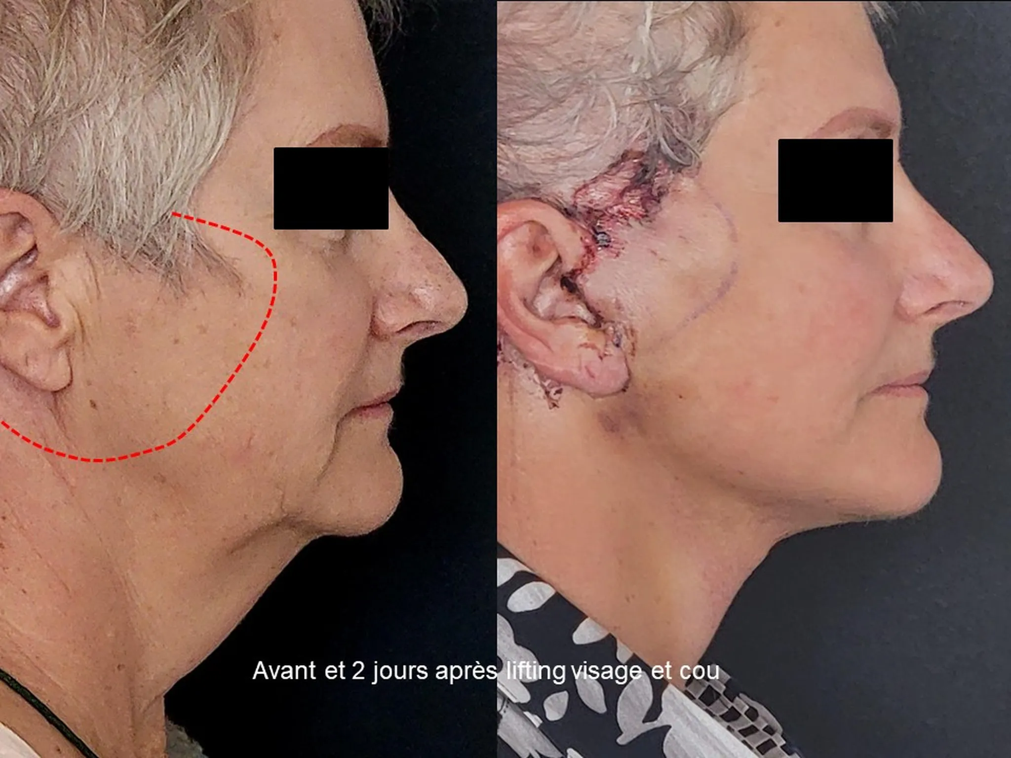 Lifting du visage sur femme