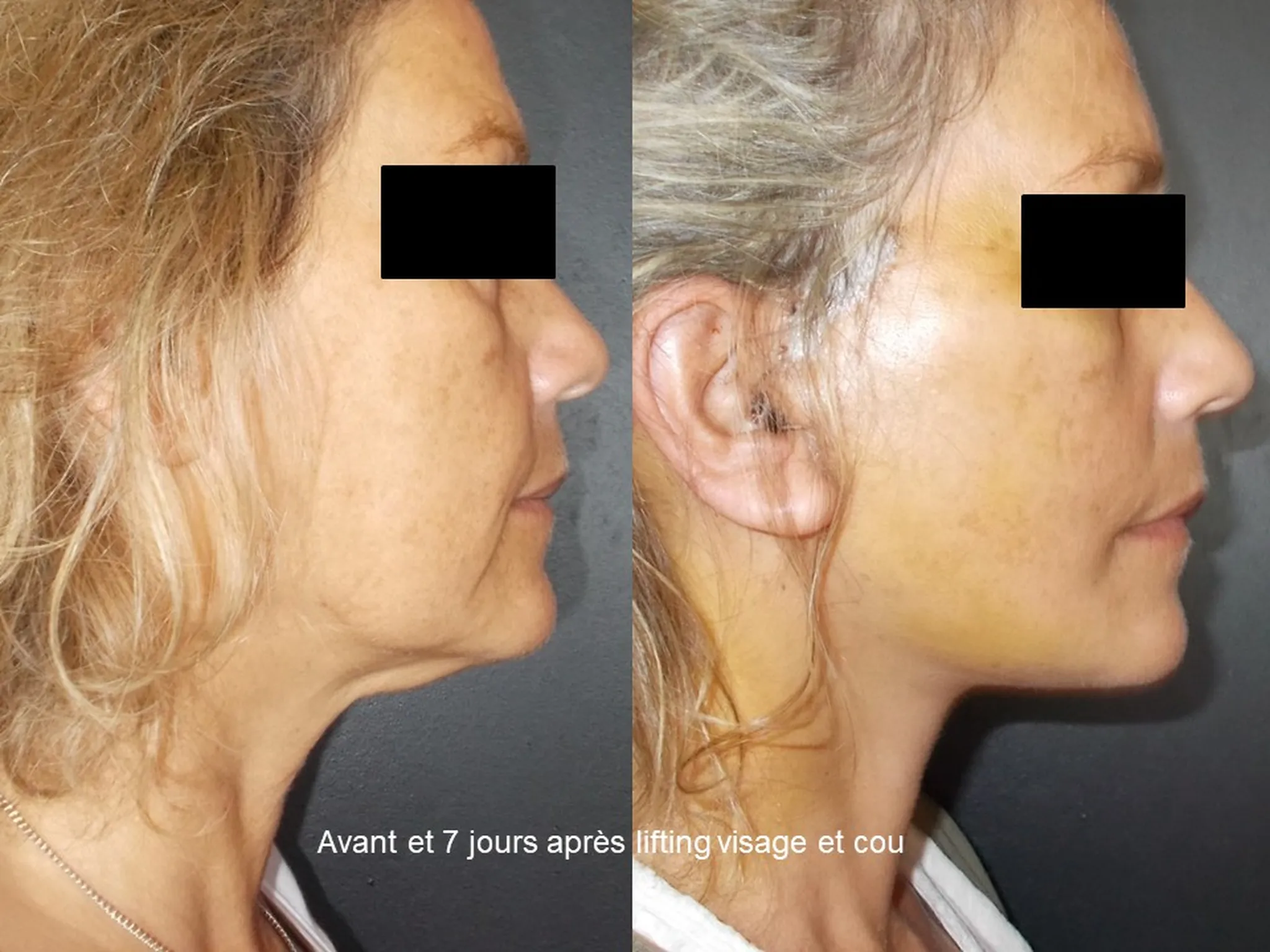 Lifting du visage sur femme