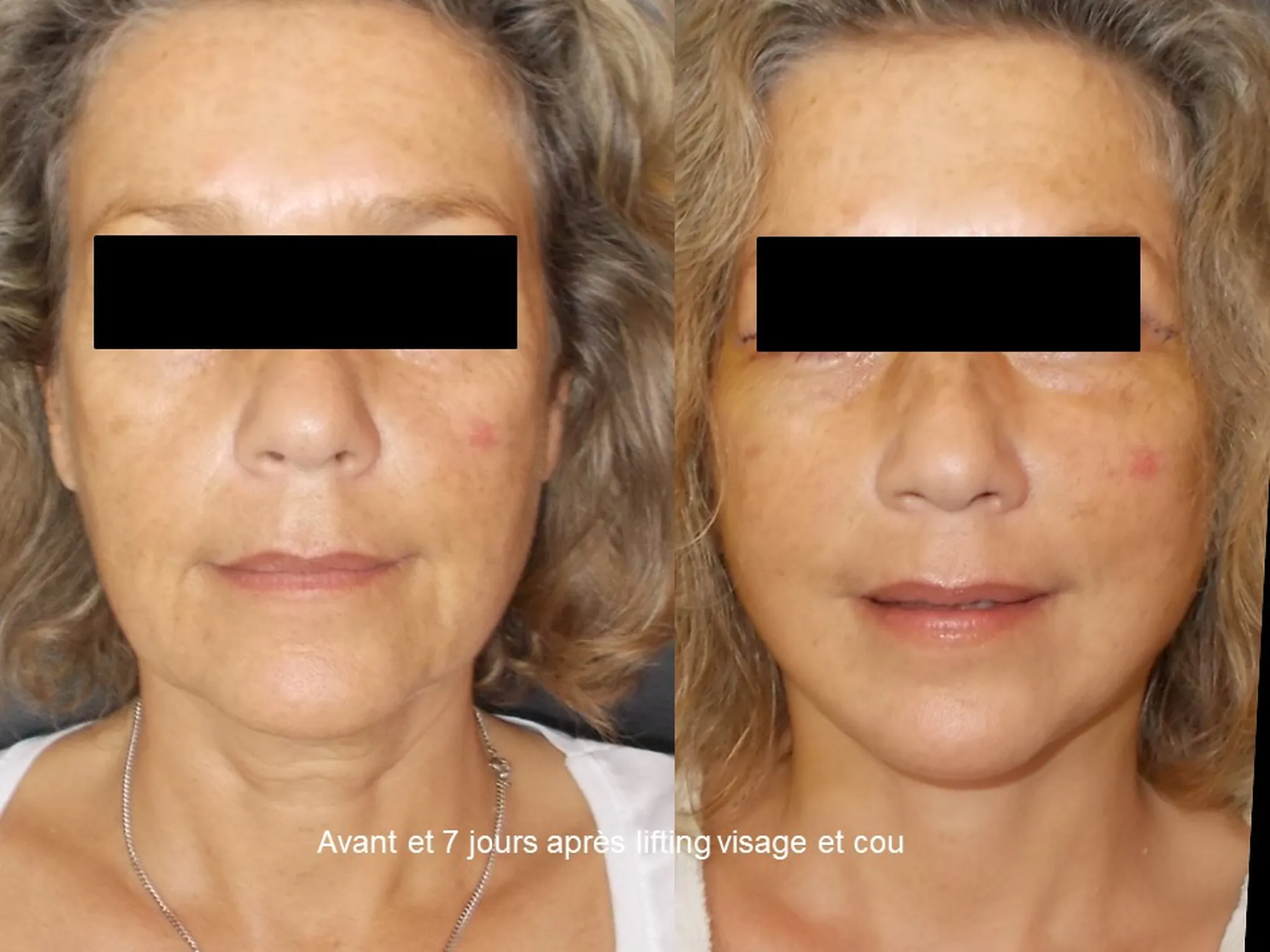 Lifting du visage sur femme