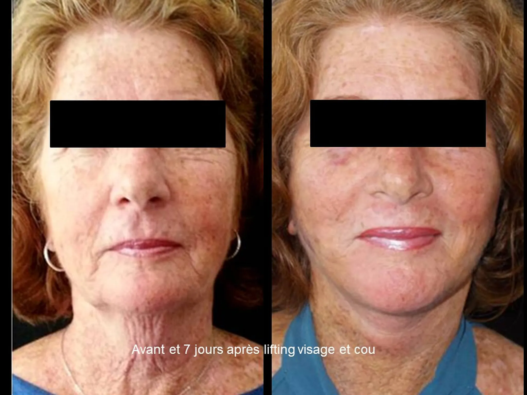 Lifting du visage sur femme
