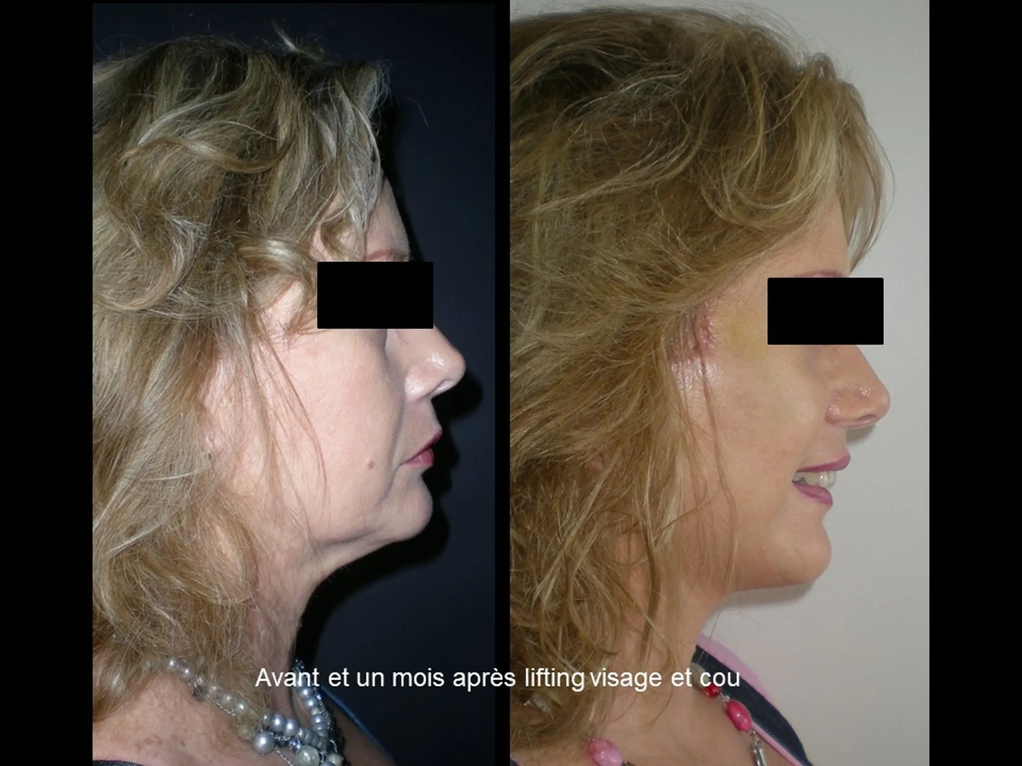 Lifting du visage sur femme
