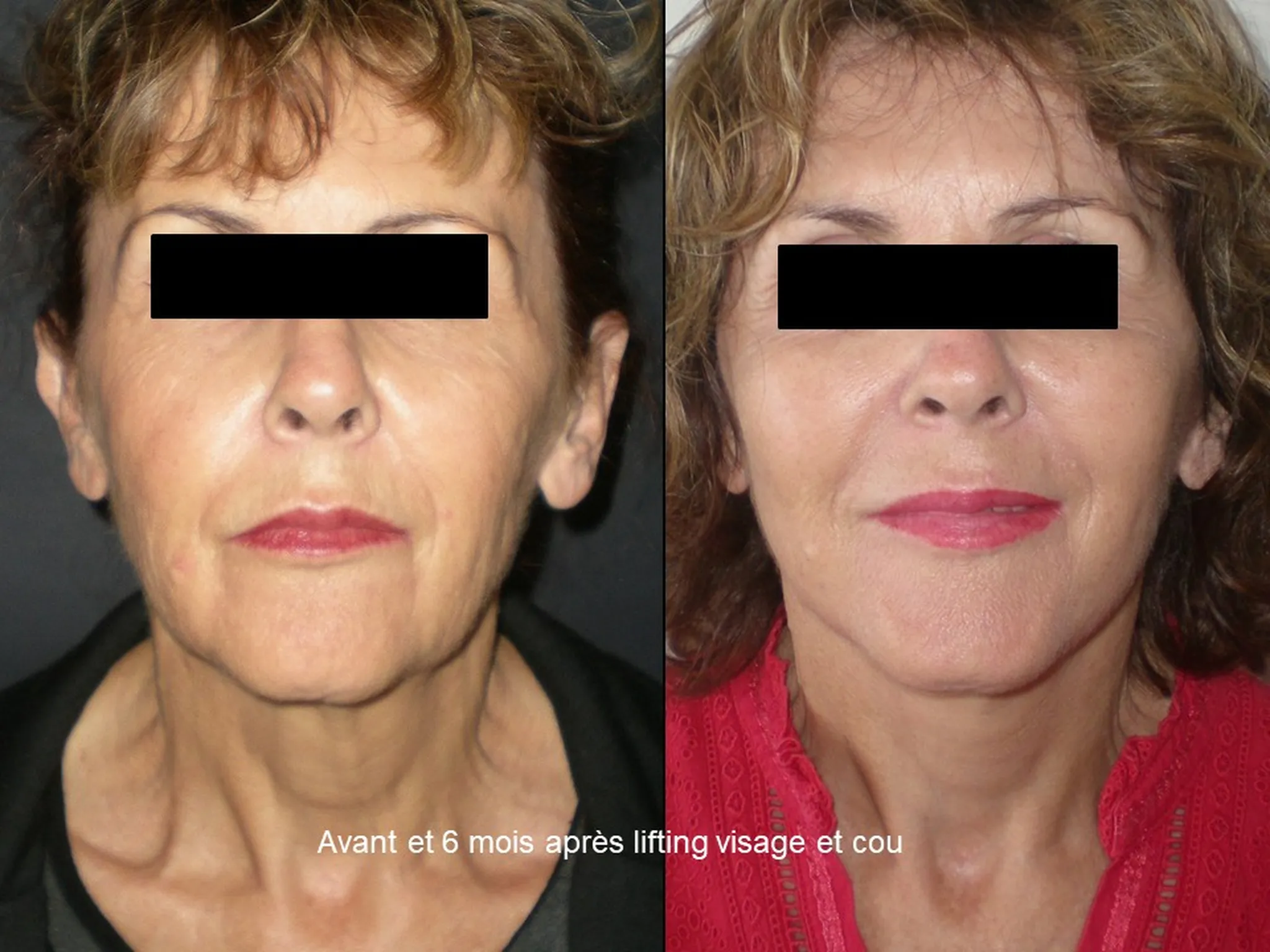 Lifting du visage sur femme