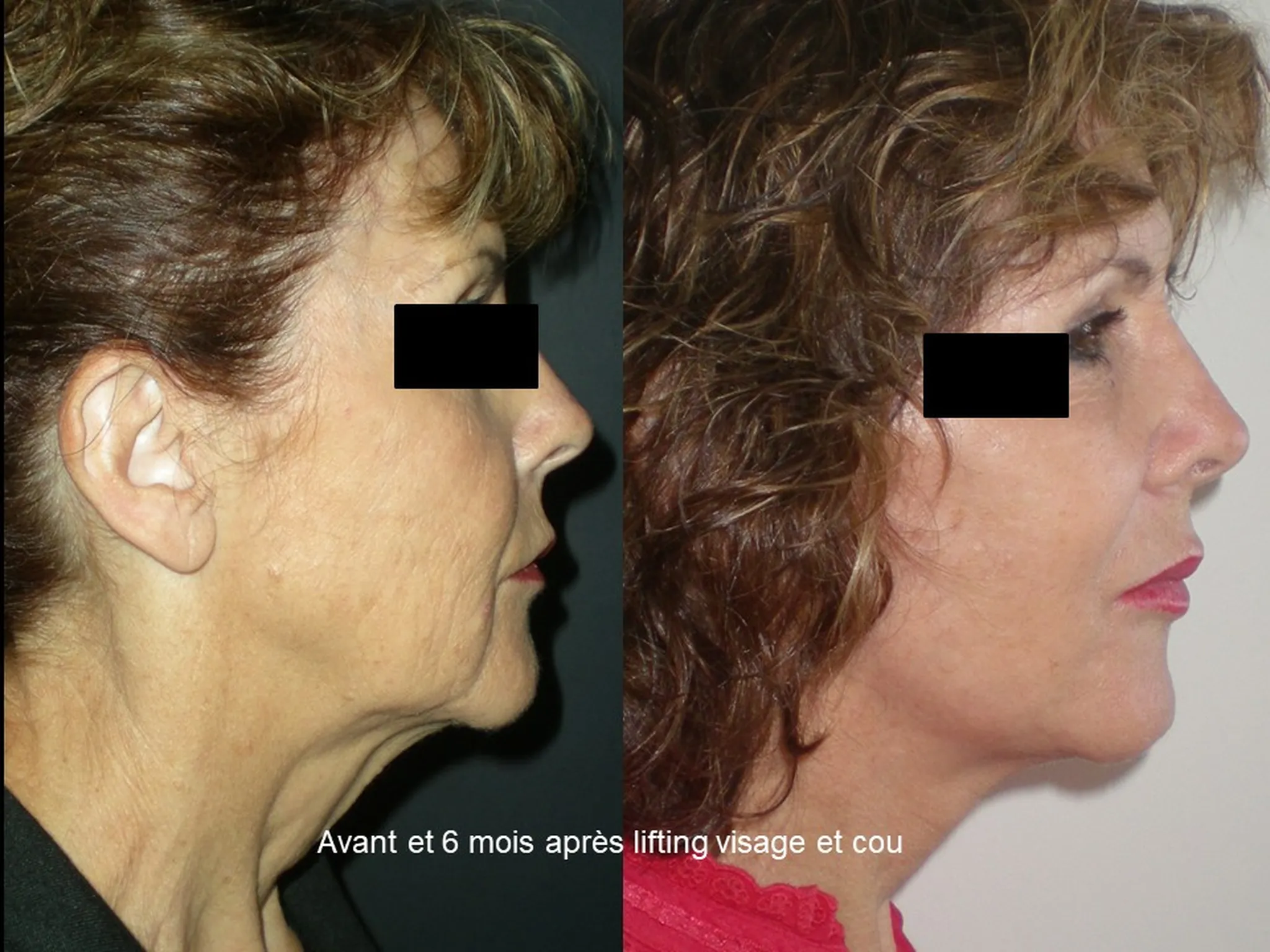 Lifting du visage sur femme