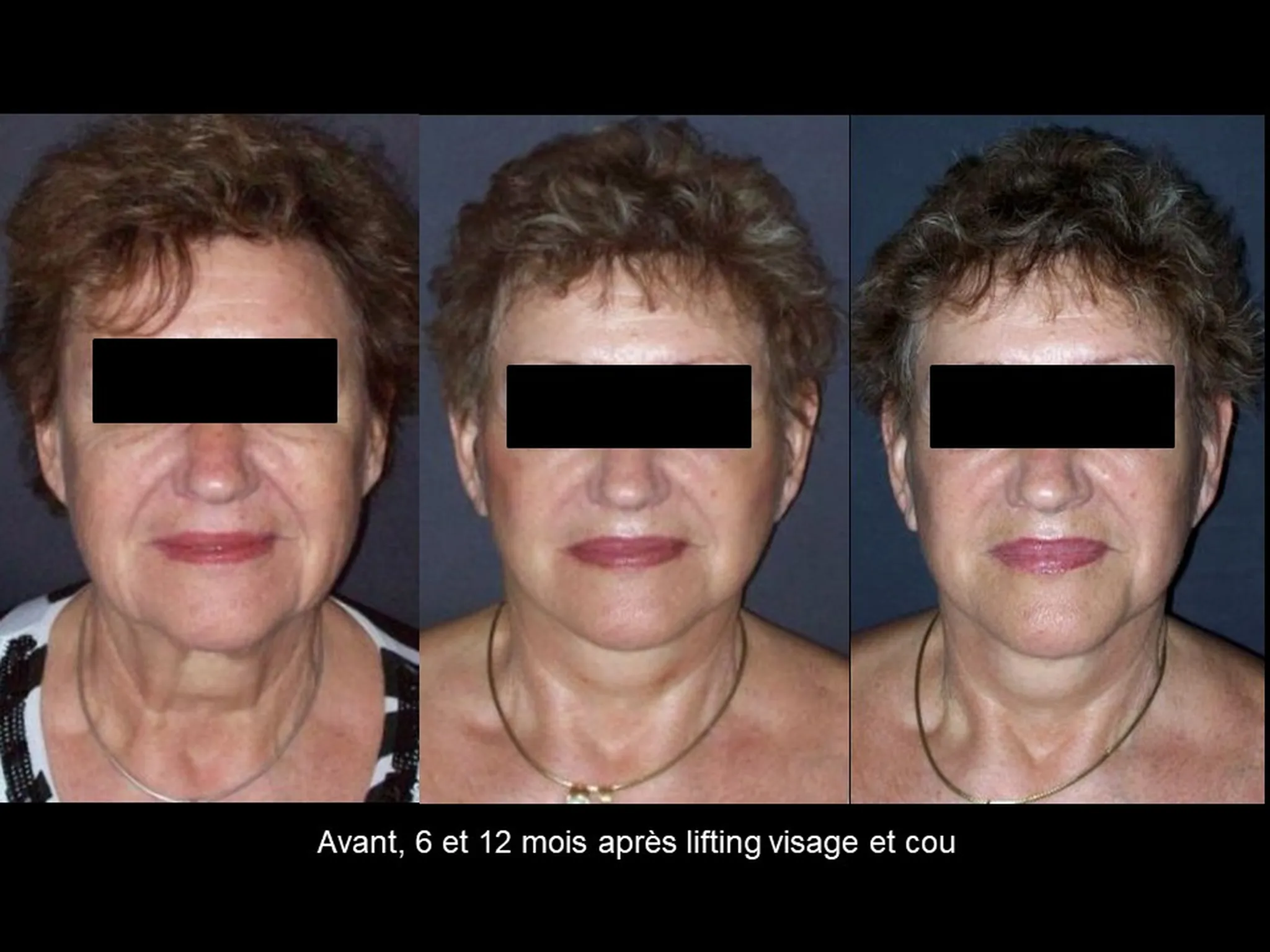 Lifting du visage sur femme