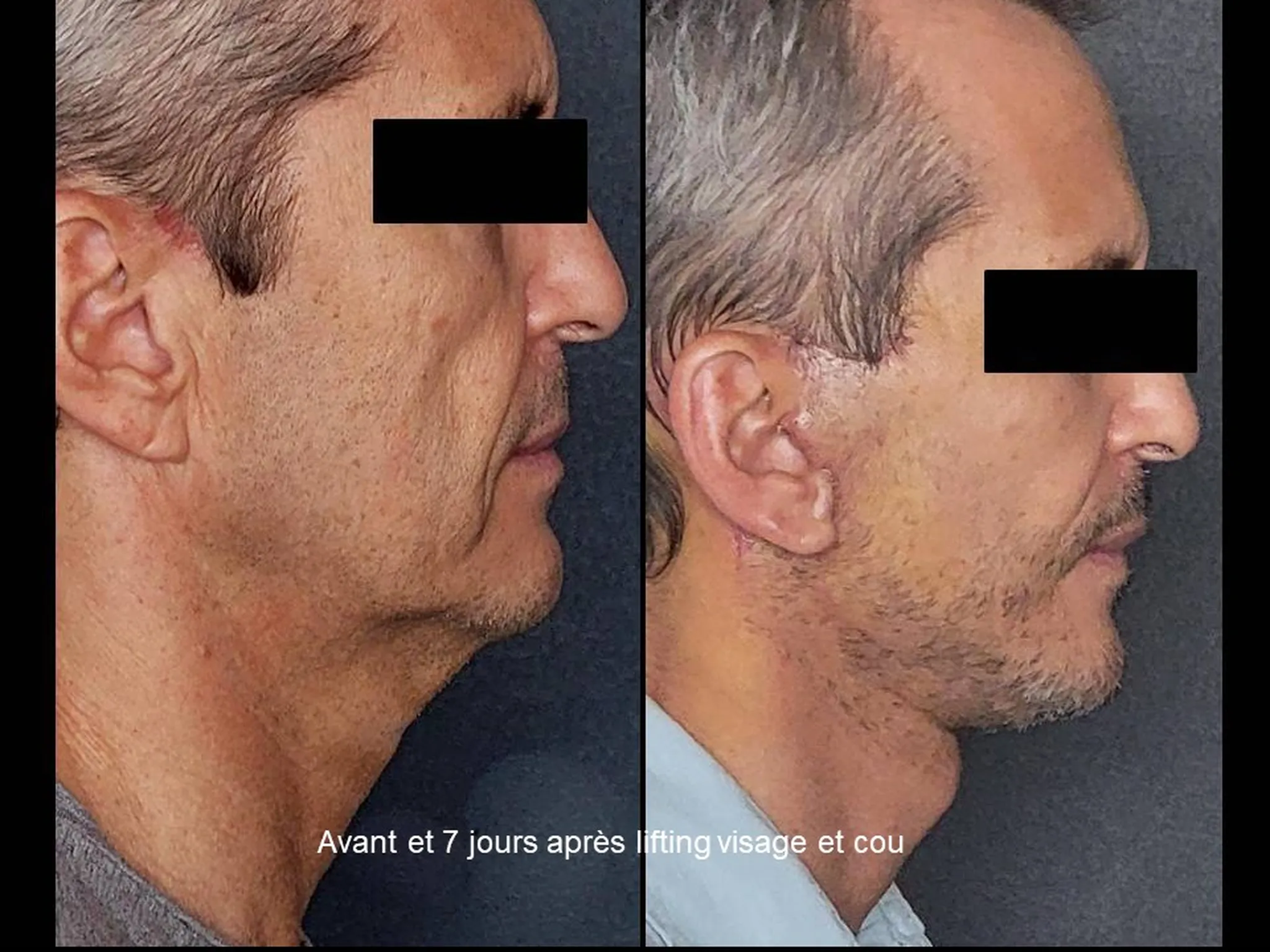 Lifting du visage sur homme