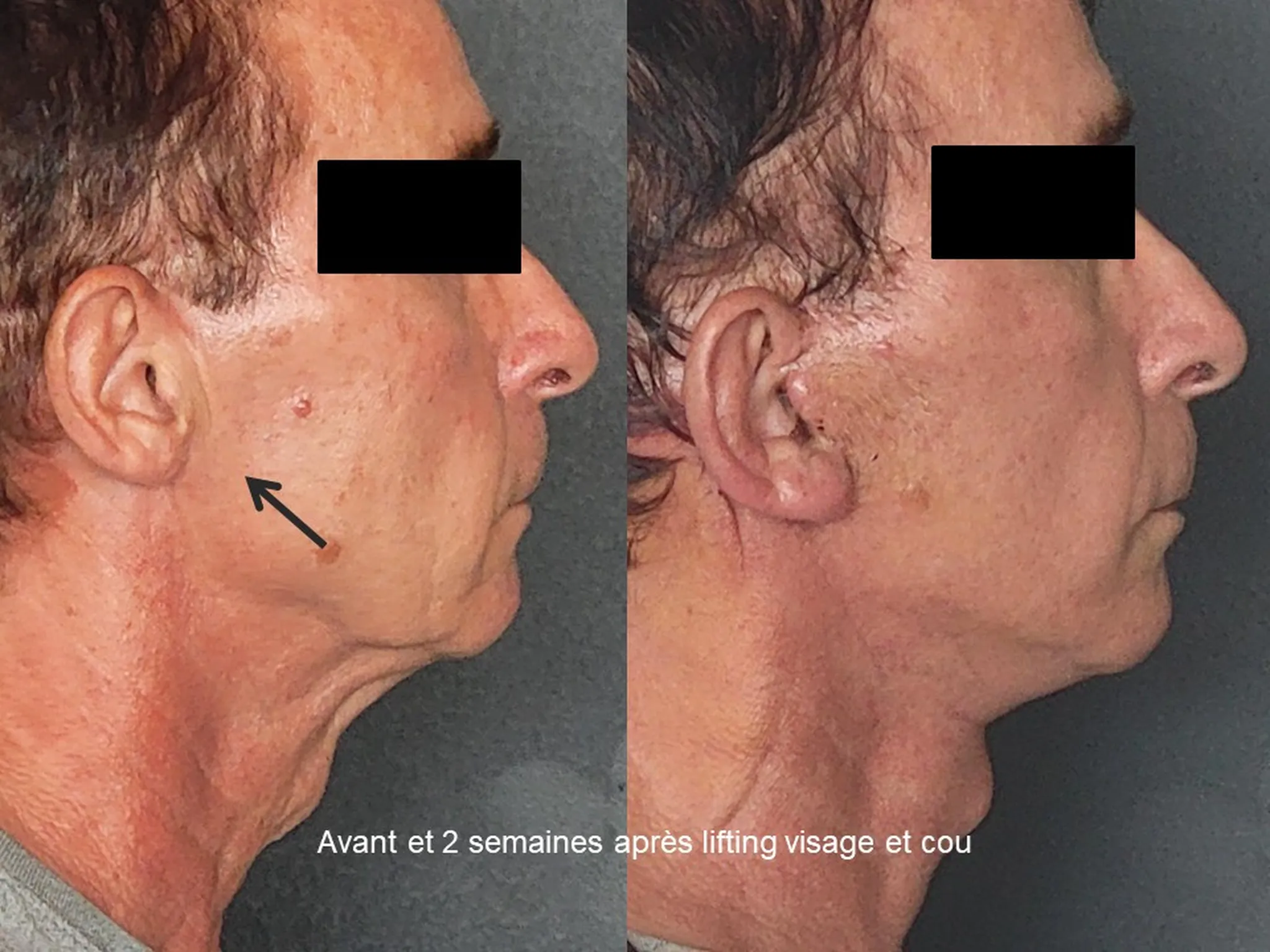 Lifting du visage sur homme