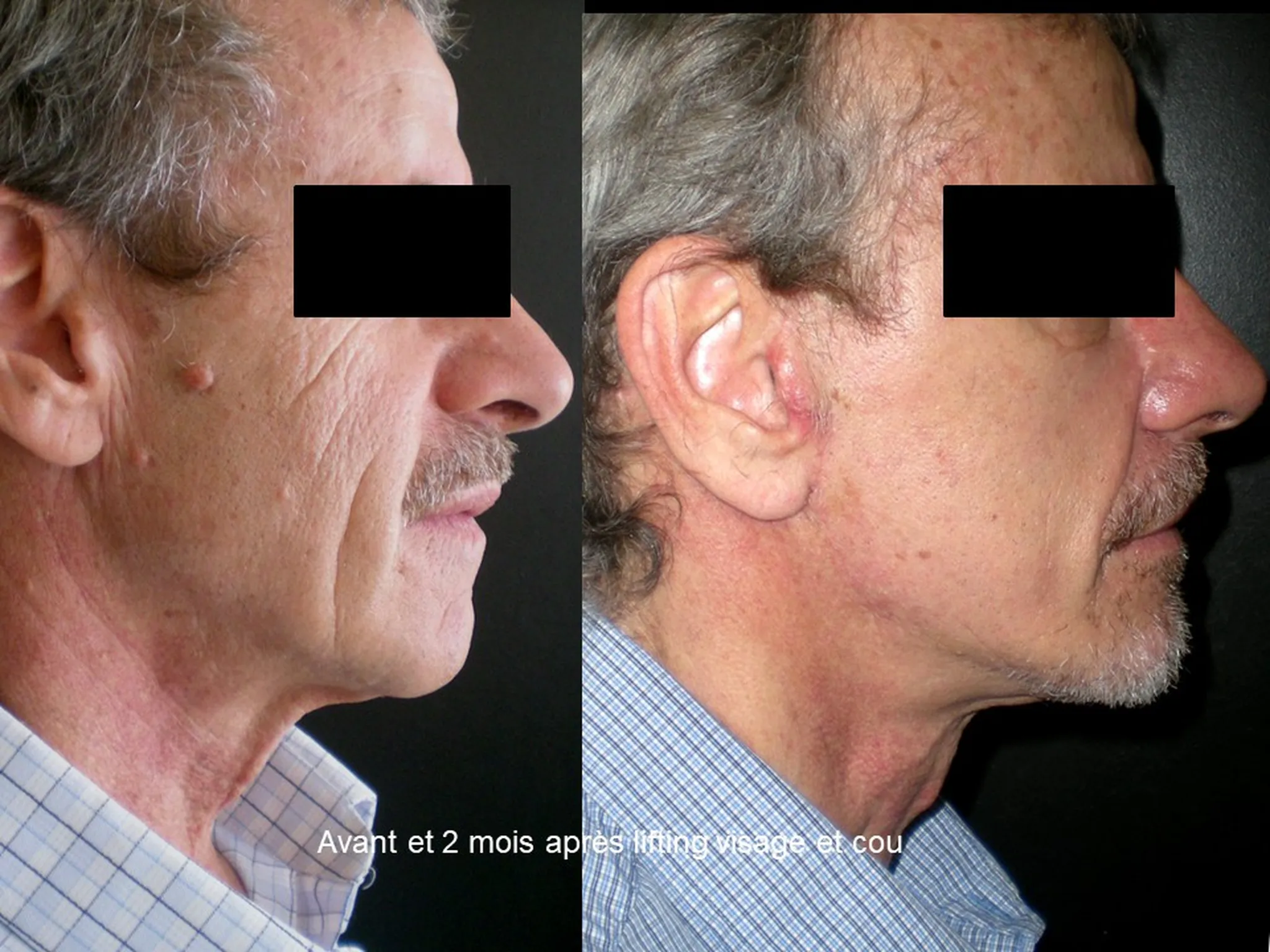 Lifting du visage sur homme