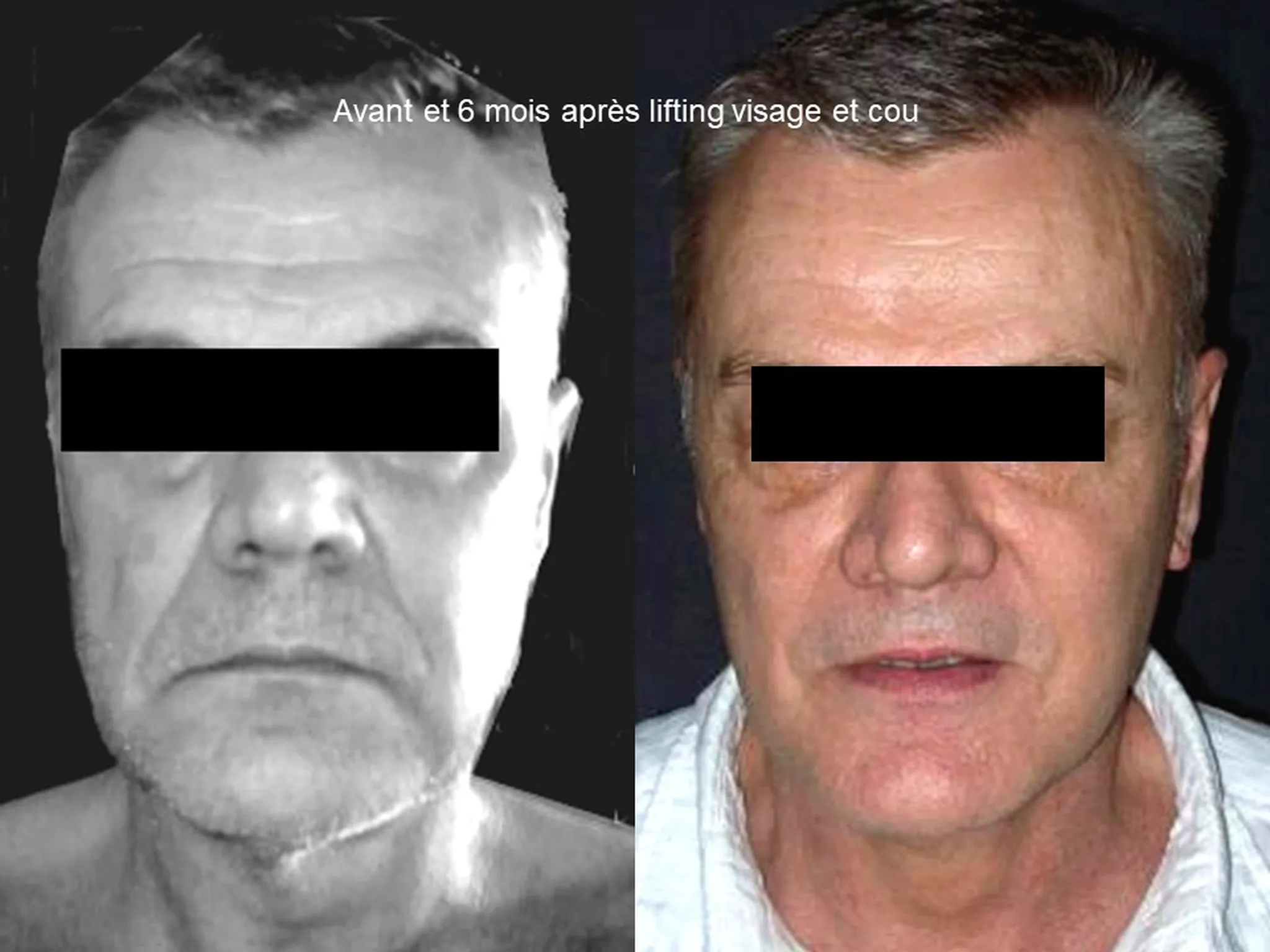 Lifting du visage sur homme